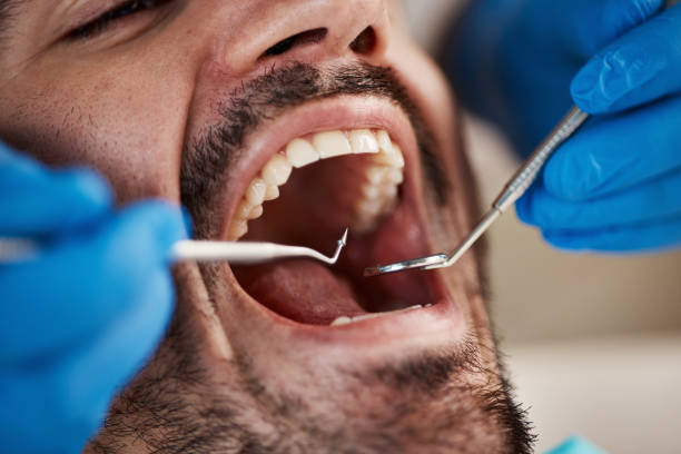 Best Emergency Dental Care for Broken or Chipped Teeth in Greensburg, IN